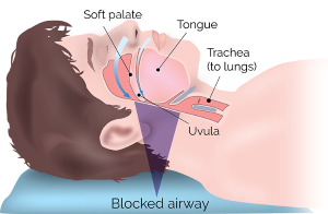 diagram of an obstructed airway, which is the cause of sleep apnea; a custom oral appliance would correct this issue