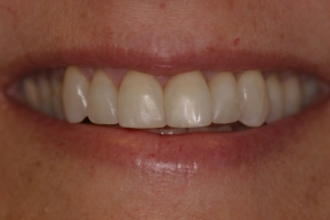 After Composite Bonding (dental patient from Niles, IL)