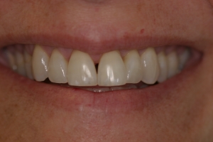 Before Composite Bonding, dental patient from Niles, IL