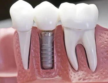 Dental implant, Wendy Shorr DDS, Skokie IL dental services