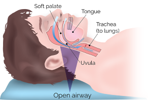 diagram of an open airway, not requiring an oral appliance