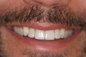 After porcelain veneers (dental patient from Highland Park, IL)