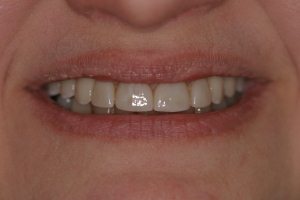 After Implant-supported bridges and porcelain veneers, Dental Implant patient from Niles, IL