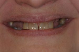 Before Implant-supported bridges and porcelain veneers, Dental Implant patient from Niles, IL