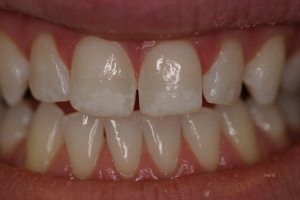 After teeth whitening, dental patient from Highland Park, IL