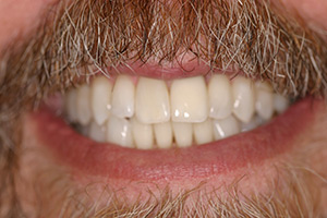 After Teeth Whitening (dental patient from Northbrook, IL)