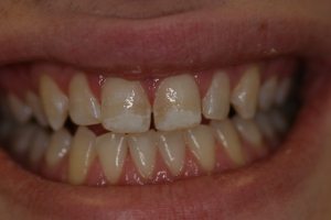 Before teeth whitening, dental patient from Highland Park, IL