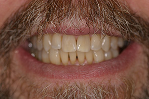 Before Teeth Whitening (dental patient from Northbrook, IL)